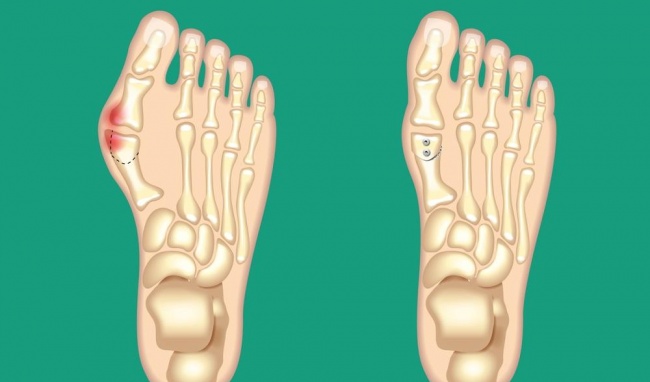 Ngón chân bị biến dạng là gì? - quy trình thực hiện và hồi phục sức khỏe